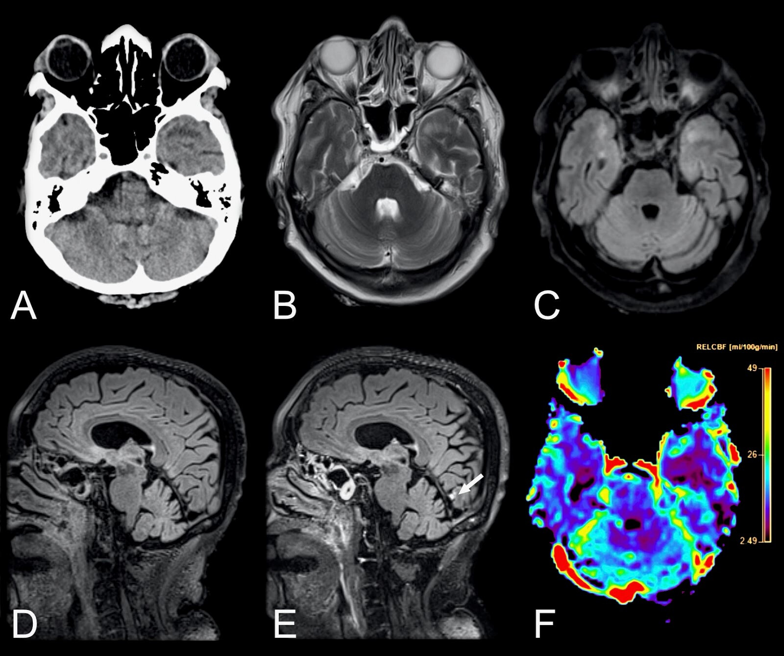 Neurological manifestations of coronavirus infections - a systematic review.