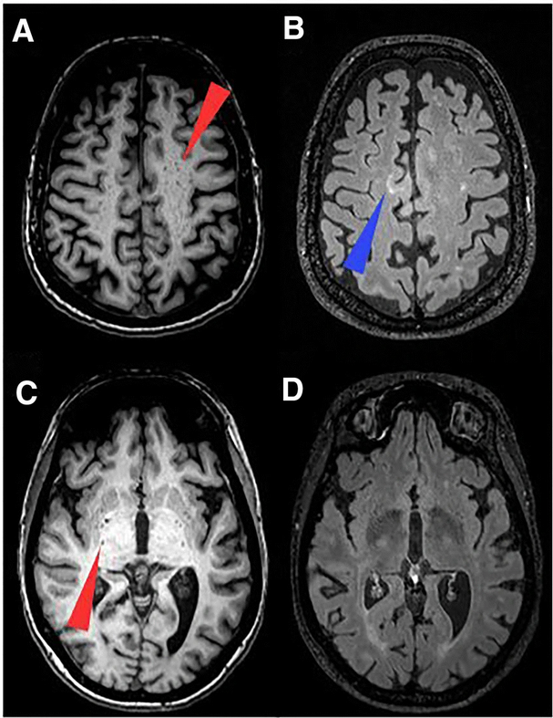 Enlarged perivascular spaces in multiple sclerosis on magnetic resonance imaging: a systematic review and meta-analysis.