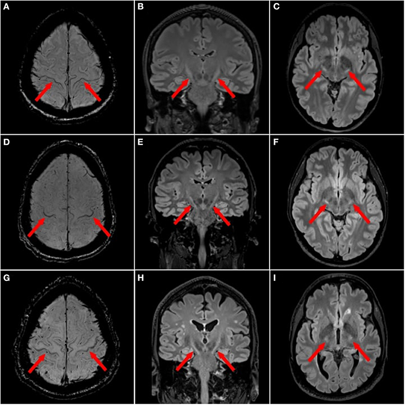 Structural magnetic resonance imaging findings and histopathological correlations in motor neuron diseases-A systematic review and meta-analysis