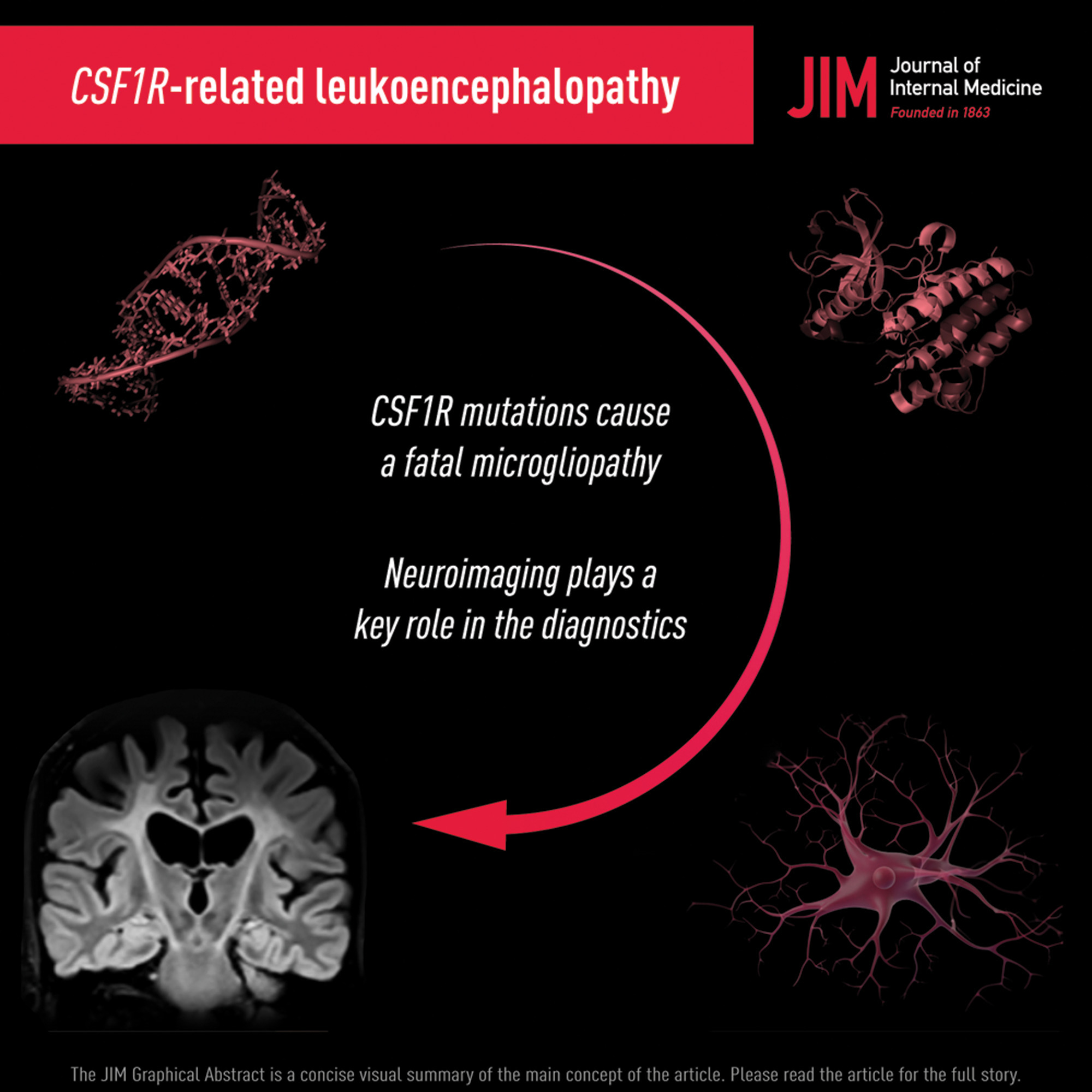 Neuroimaging phenotypes of CSF1R-related leukoencephalopathy: Systematic review, meta-analysis, and imaging recommendations.