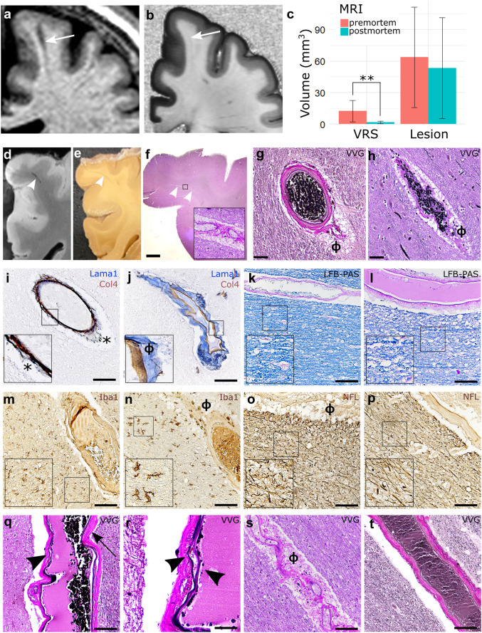 Virchow-Robin spaces are a marker for arterial disease in multiple sclerosis.