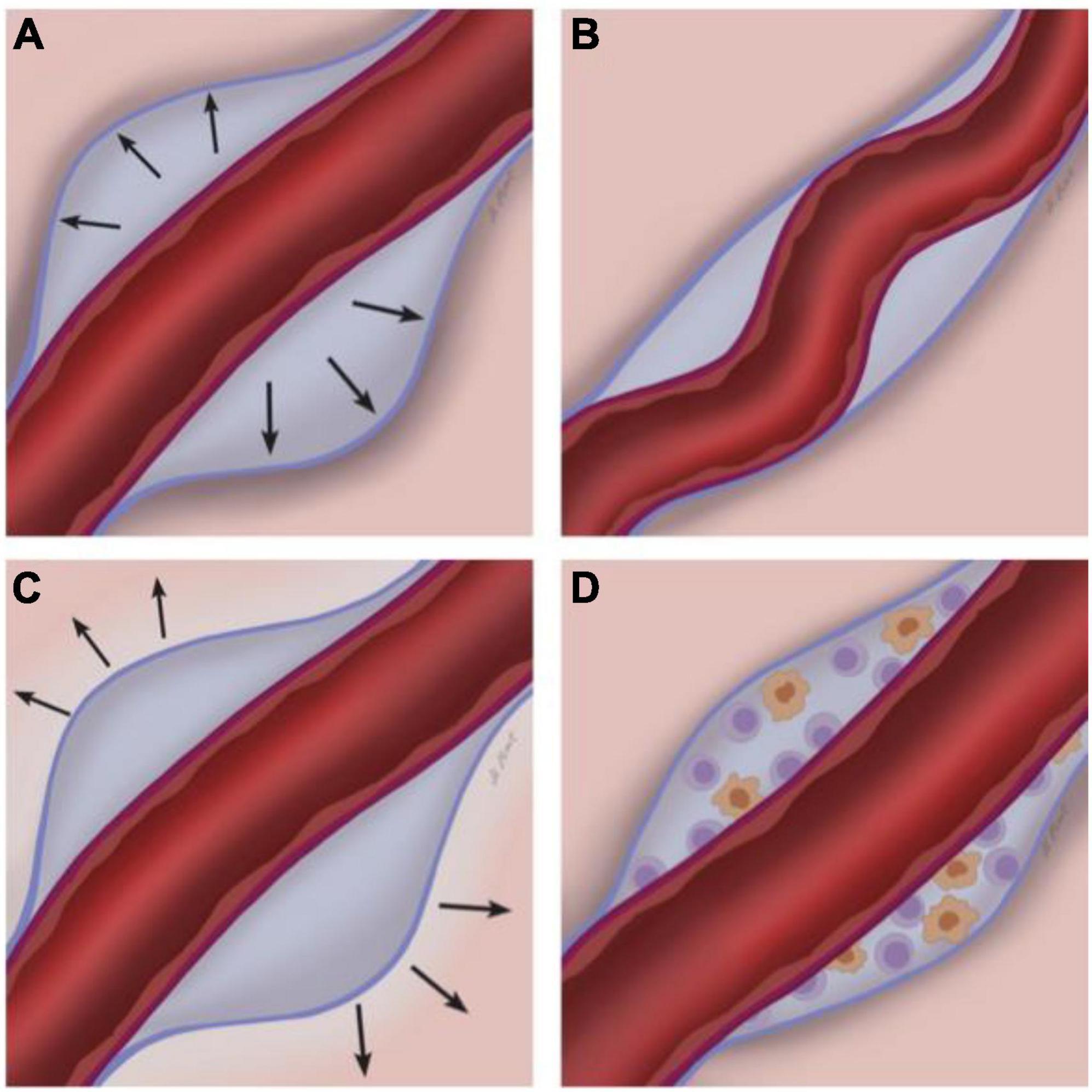 The etiology and evolution of magnetic resonance imaging-visible perivascular spaces: Systematic review and meta-analysis.