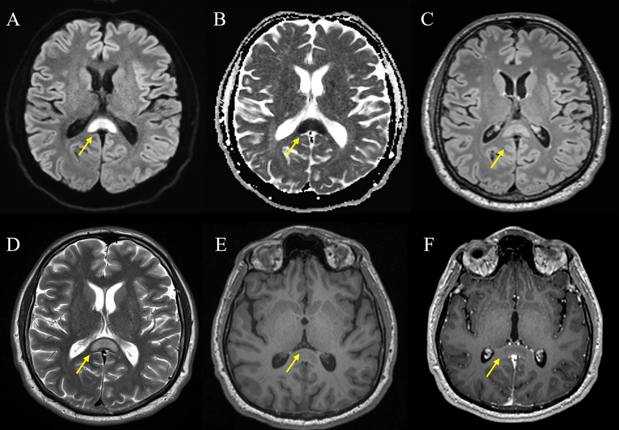 Cytotoxic lesions of the corpus callosum: a systematic review.