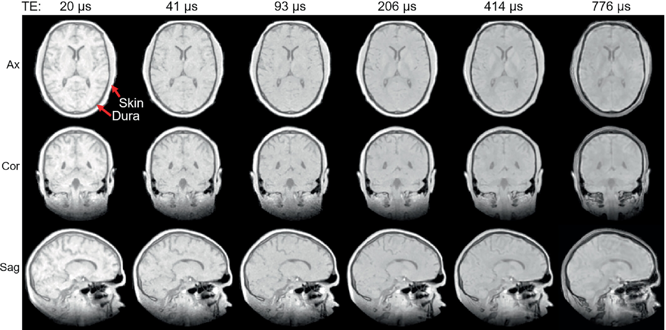 Myelin bilayer mapping in the human brain in vivo.