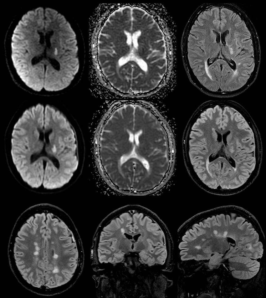 Misdiagnosis and underdiagnosis of multiple sclerosis: A systematic review and meta-analysis.